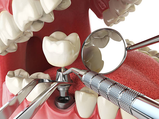 Best Lost Filling or Crown Replacement in Calcutta, OH